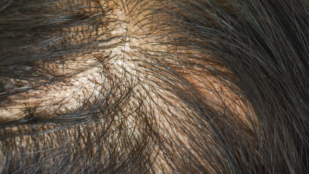 Eli Lilly Expands Horizons with Major Investment in Hair Growth Startup Absci