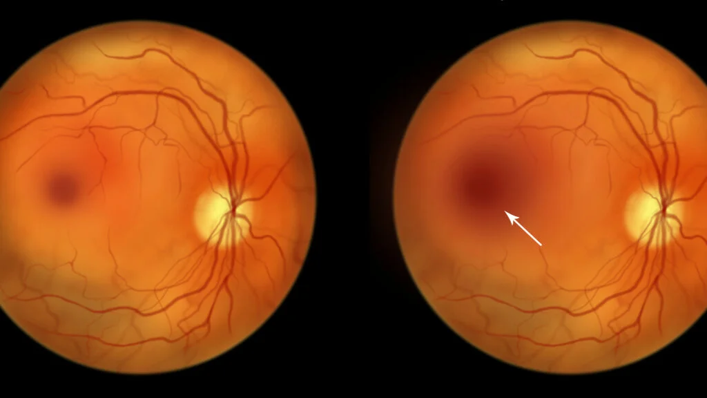 Ollin Biosciences Secures $330 Million for Late-Stage Eye Disease Trials