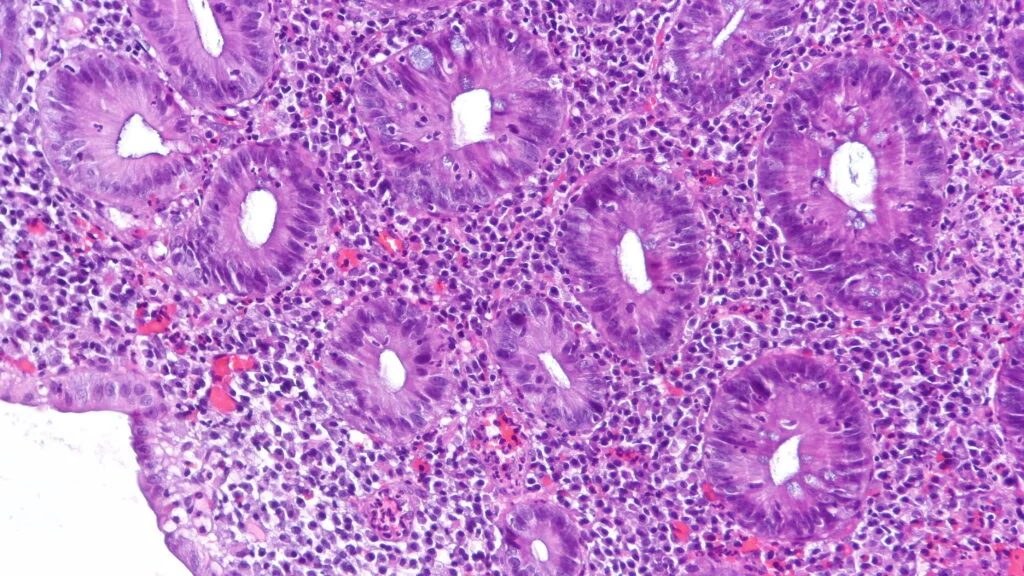 Akero's Former Leaders Launch Avere Therapeutics Focusing on Immunology