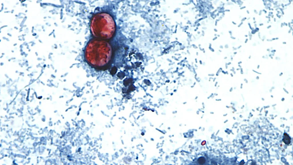 Federal Health Officials Investigate New Cyclospora Outbreak Affecting 72 Individuals