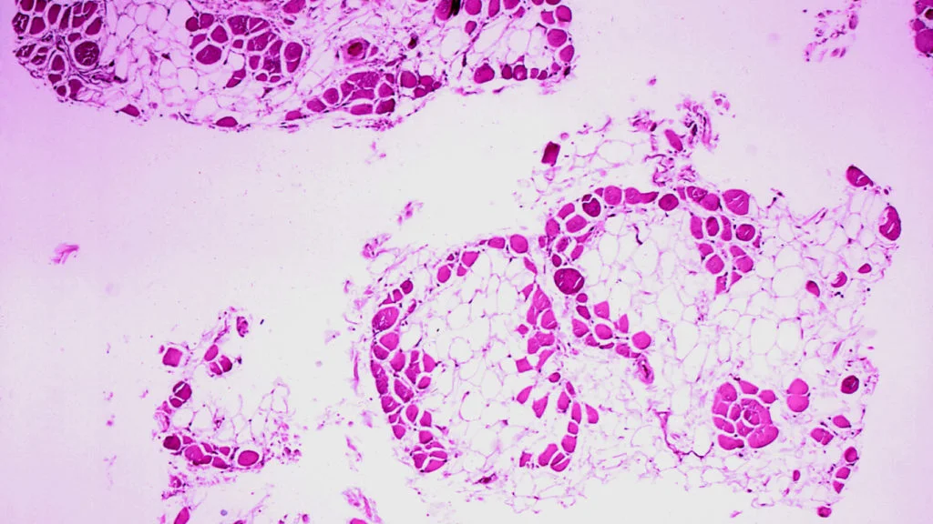 Capricor's Duchenne Treatment Faces Scrutiny as FDA Committee Reviews Efficacy