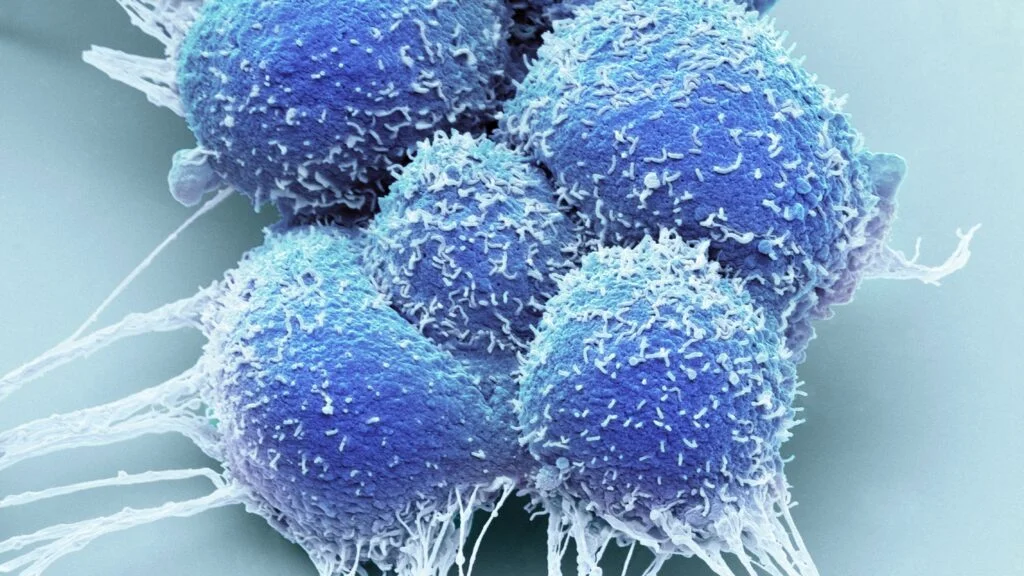 Emerging Focal Therapy for Prostate Cancer: A Shift in Treatment Paradigms