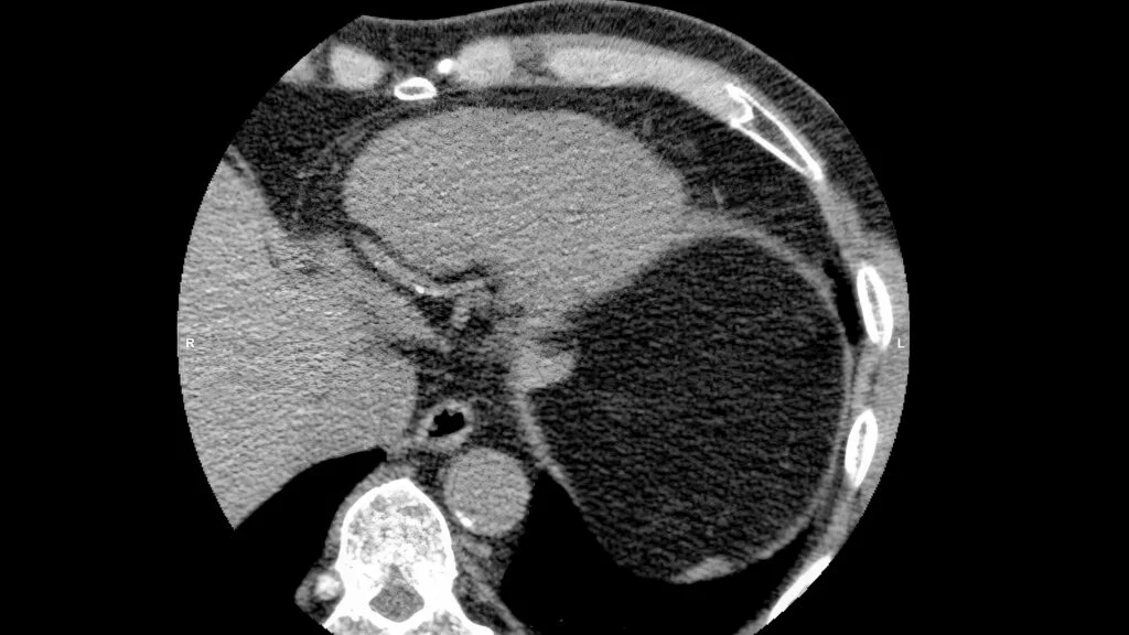 Evaluating Heart Risk: The Role of Calcium Scans in Statin Decisions