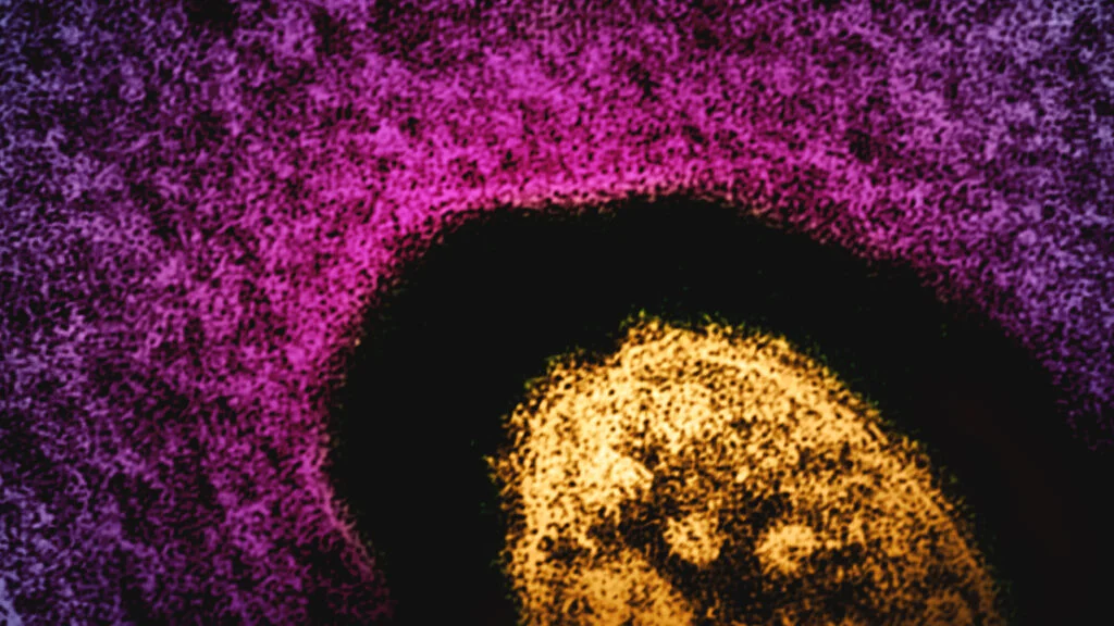 Tension Between CDC and States Complicates Measles Outbreak Response