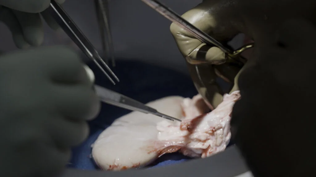 Biotech Breakthrough: Recipients of Gene-Edited Pig Kidneys Successfully Transition to Human Organs