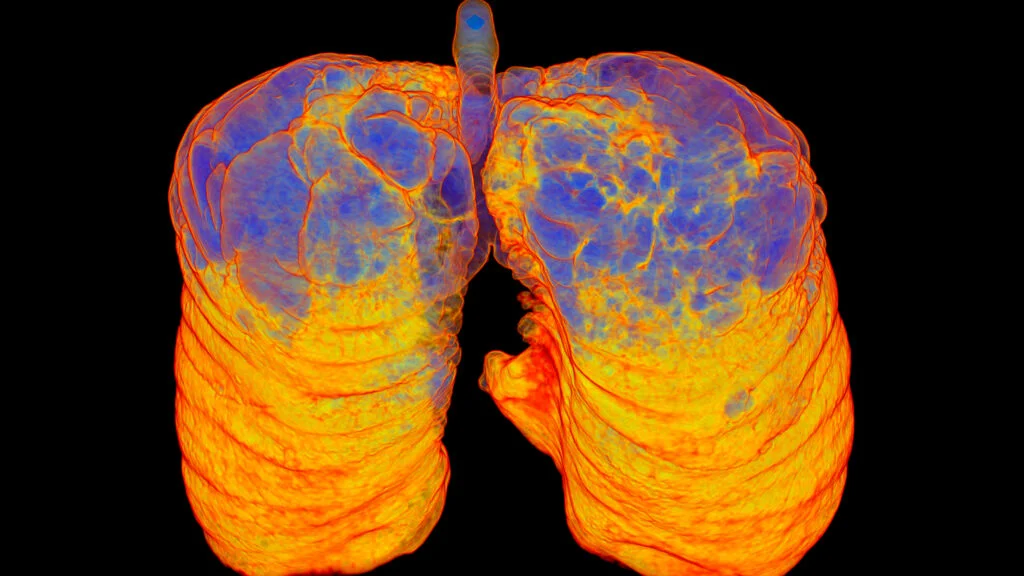 AstraZeneca's Tozorakimab Shows Promise as a New COPD Treatment