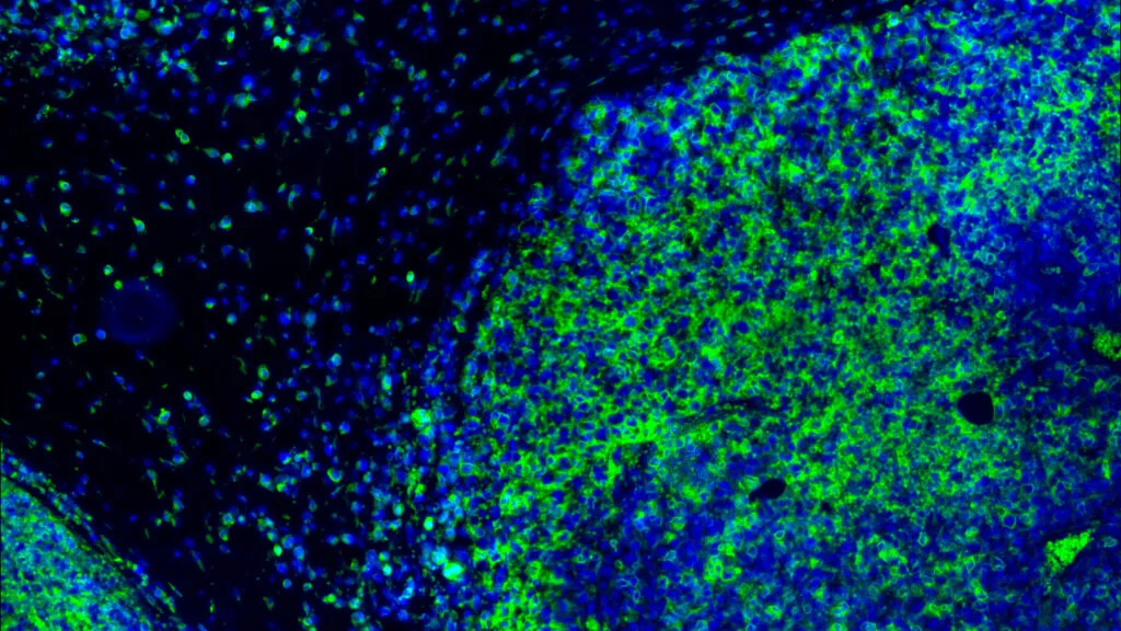 Inhibrx Achieves Milestone in HPV-Positive Head and Neck Cancer Treatment with OX40 Immunotherapy