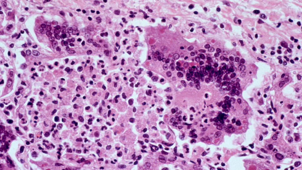 Measles Surge in the U.S.: Worst Outbreak Since 1991 Raises Alarm
